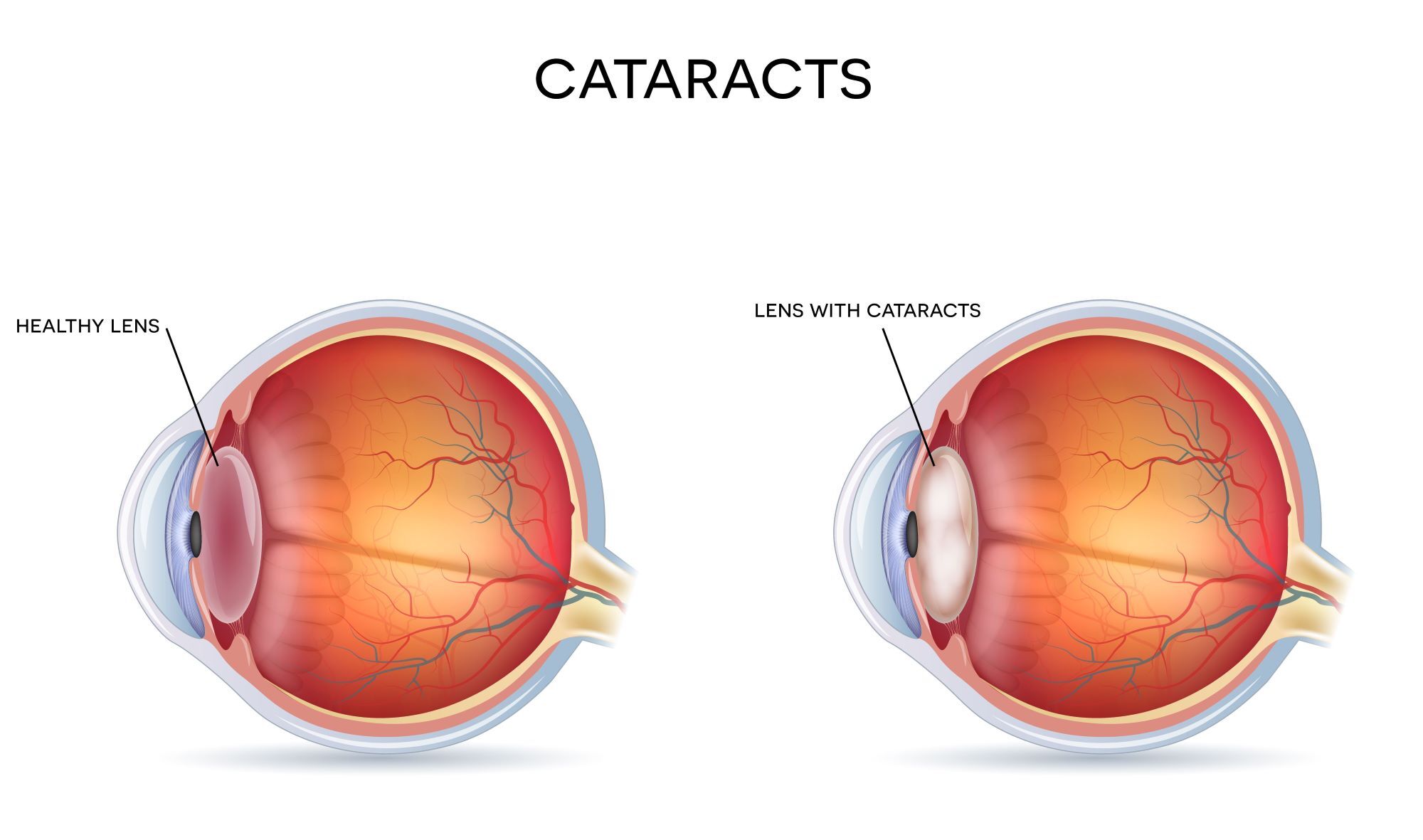 Does Medicare Cover Cataract Surgery in 2024? SeniorResource